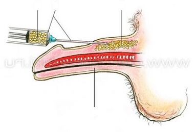 Μεγέθυνση πέους με ένεση